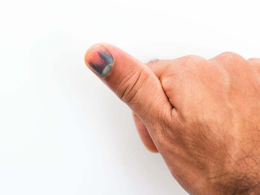 Bloeduitstorting onder je nagel: alles wat je moet weten | Etos